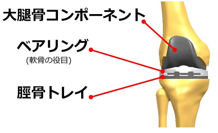 人工膝関節