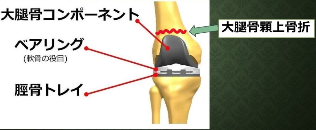 大腿骨顆上骨折2