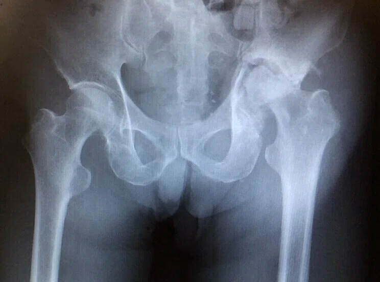Hip